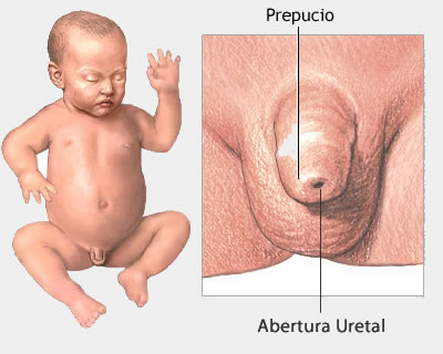 Circuncisión